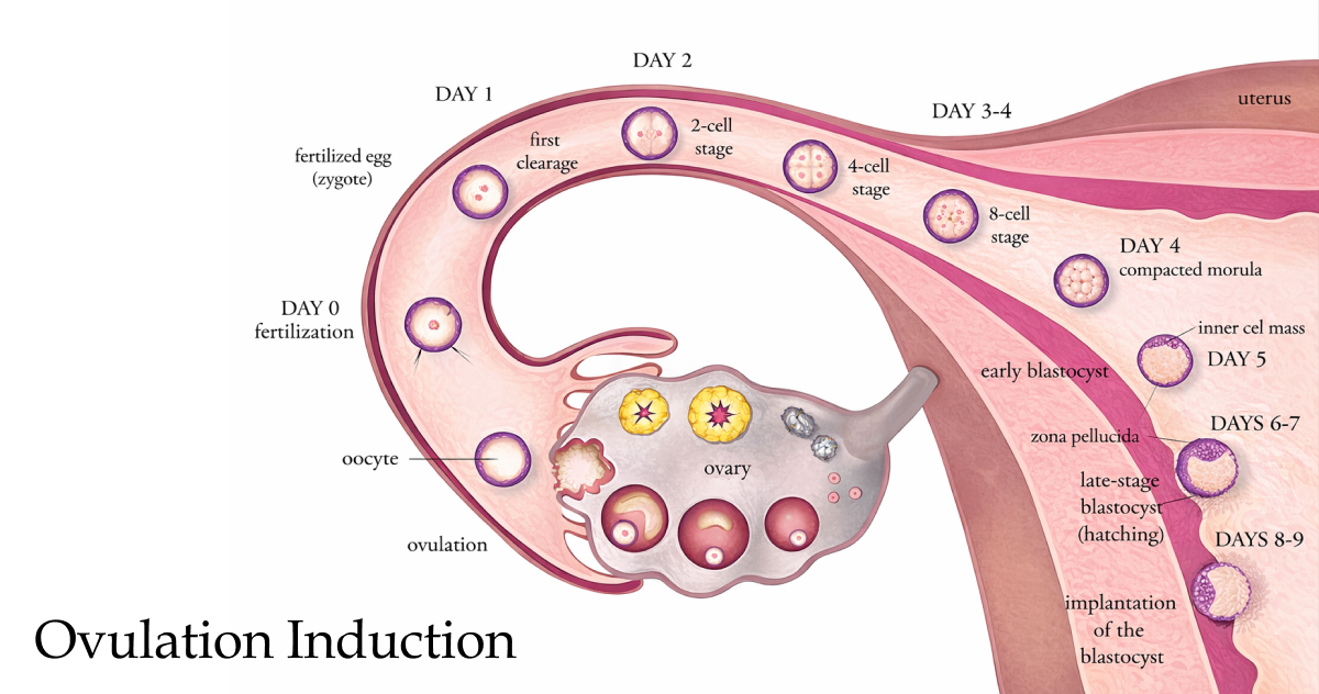 Ovulation induction is a fertility treatment that uses medications to stimulate the ovaries to produce and release eggs.